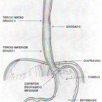 Reflujo Gastroesofágico en Pediatría