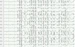 Que es el VideoElectroencefalograma, EEG, con Mapeo Cerebral
